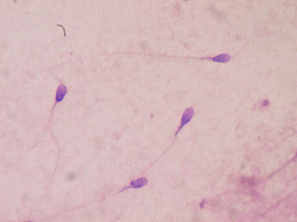 rare-semen-allergy-may-cause-fertility-complications-in-women