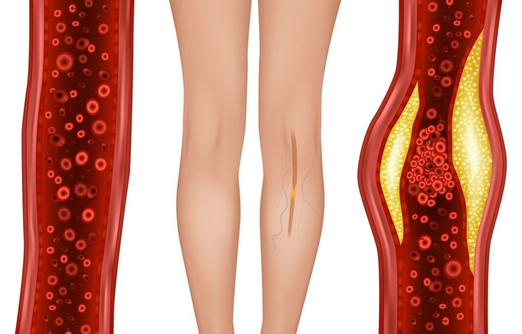 Περιφερική αρτηριοπάθεια: Γιατί οι γυναίκες κινδυνεύουν περισσότερο – Θεραπείες που σώζουν τα κάτω άκρα Περιφερική-αρτηριοπάθεια:-Γιατί-οι-γυναίκες-κινδυνεύουν-περισσότερο-–-Θεραπείες-που-σώζουν-τα-κάτω-άκρα