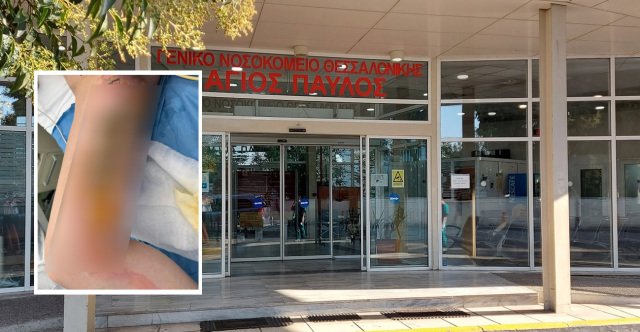 Εφιάλτης για 20χρονη στη Θεσσαλονίκη: Μπήκε στο νοσοκομείο για αφαίρεση κύστης κόκκυγα και κατέληξε με εγκαύματα τρίτου βαθμού Εφιάλτης-για-20χρονη-στη-Θεσσαλονίκη:-Μπήκε-στο-νοσοκομείο-για-αφαίρεση-κύστης-κόκκυγα-και-κατέληξε-με-εγκαύματα-τρίτου-βαθμού